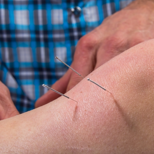 dry-needling-primtetime-physical-therapy-destin-niceville-fort-walton-beach-FL
